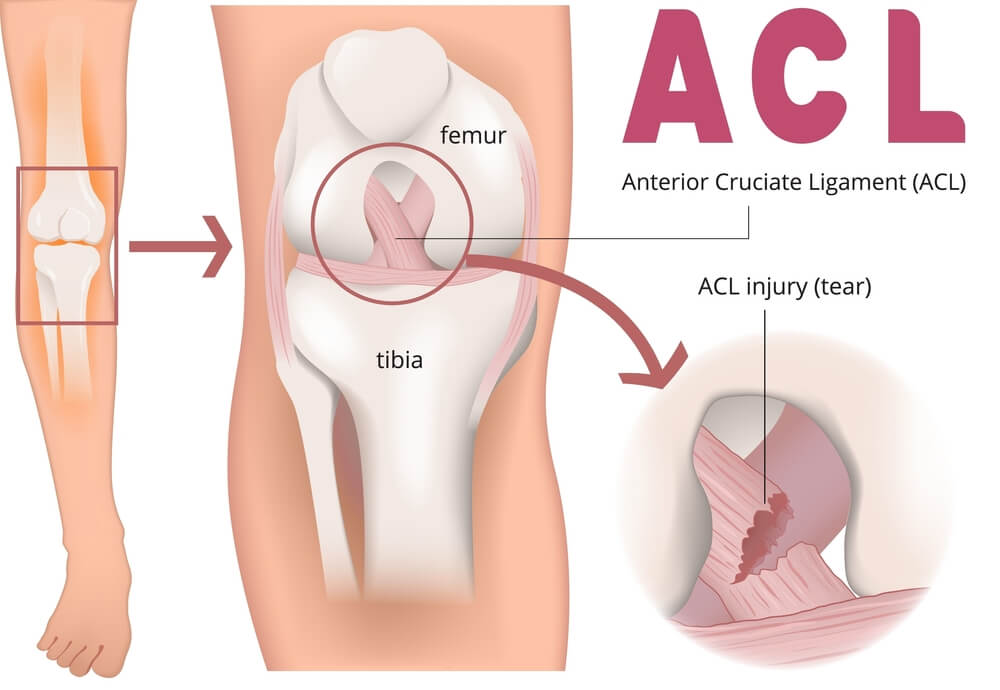 ACL Rehabilitation