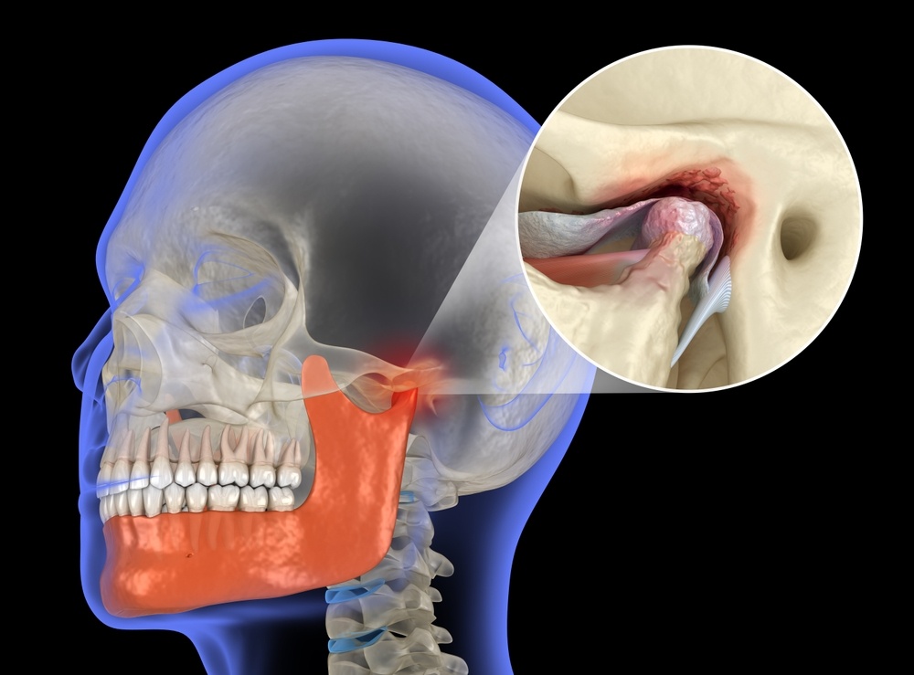 What Are Some Jaw Exercises to Reduce TMJ Pain?